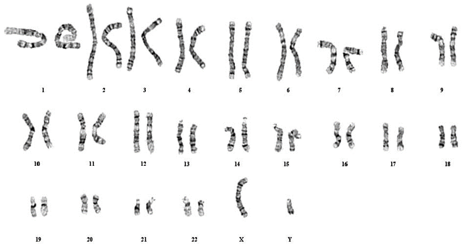 prader willi syndrome karyotype