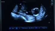 Whitney Dean and Zack Hudson - Baby Scan of Peach Dean (18 January 2023)