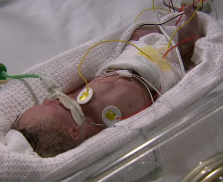 Johnny in his incubator after being born prematurely