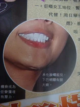 20081221 joey face lift