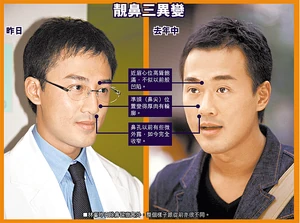 林峯鼻子的「變遷」