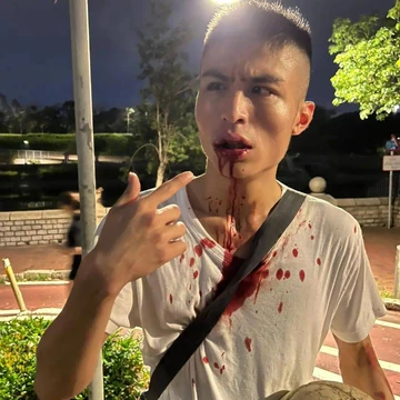 劉馬車街頭遇襲口部不停吐血