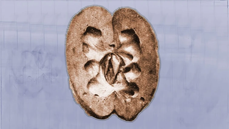 A Dad Mistakenly Drank A Lava Lamp At Bedtime. This Is What Happened To His Kidneys.