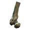 Broken femur