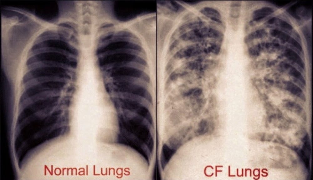 cystic fibrosis lungs vs healthy lungs