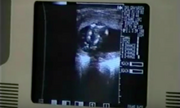 Michaelultrasound-1