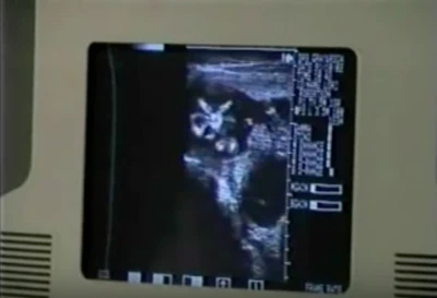 Michael during an ultrasound