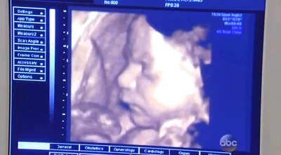 Rocco during an ultrasound