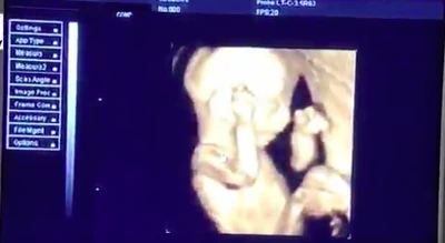 Ultrasound picture