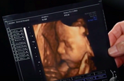 TeddyUltrasound1