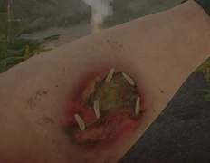 Maggots used on infected wound