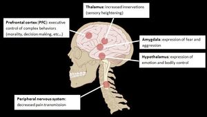 Talon Altered Neuroanatomy