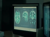 Encephalitis