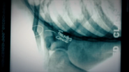 Margaret's fractured clavicle.