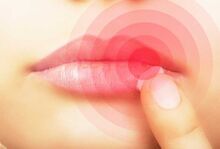 Cold sores.jpg