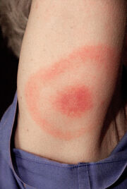 Erythema migrans - erythematous rash in Lyme disease - PHIL 9875