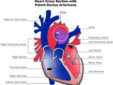 Patent ductus arteriosus