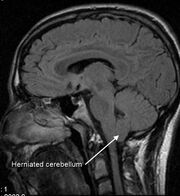 MRI of human brain with type-1 Arnold-Chiari malformation and herniated cerebellum