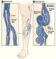 Diagram of a varicose vein, courtesy NIH, via Wikipedia