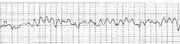 EKG VF