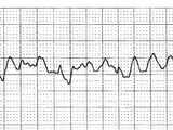 Ventricular fibrillation