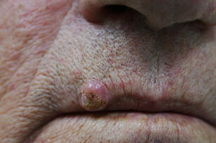 Alldaygeneric Herpes Shingles.jpg