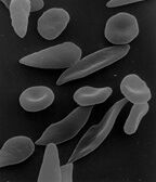 Sickle cell disease - Wikipedia