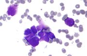 Small cell lung cancer - cytology