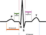 Sinus rhythm