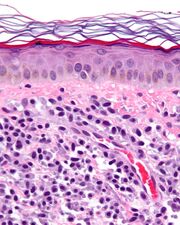 Mastocytosis - cropped - very high mag