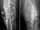 Venogram