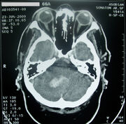 Head CT stroke