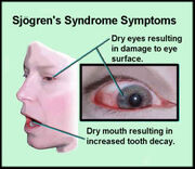 Sjogrens