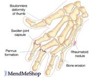 Rheumatoid arthritis