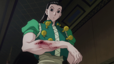 21 - Illumi's broken arm