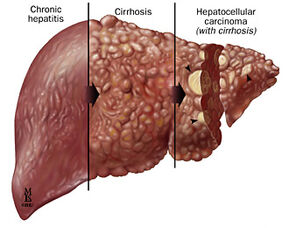 Hepatite6