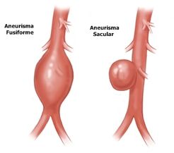 Aneurisma2