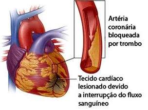 Infarto 3