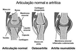 ArtriteIdiopá2