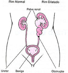 Nefrolitiase02