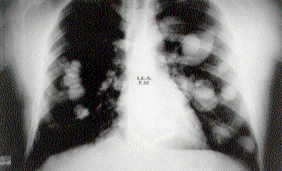 Osteossarcoma 2