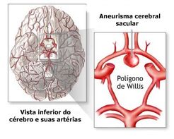 Aneurisma3