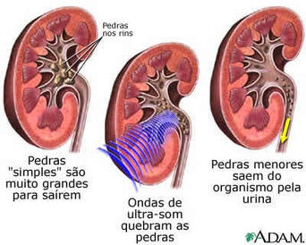 Nefrolitiase03