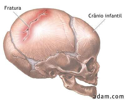 Traumatismo Cranioencefalico Tce Infomedica Wiki Fandom