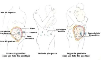 Doenca Hemolitica Perinatal Infomedica Wiki Fandom