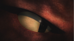 Rumblehorn eye