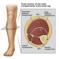 Compartment Syndrome