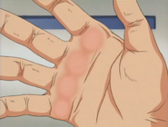 In the English dub, the skin on his hand looks raw but is not blistered.