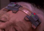 Cortical stimulator, 2369