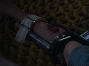 Una's broken leg